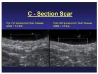 C-section scar release before and after